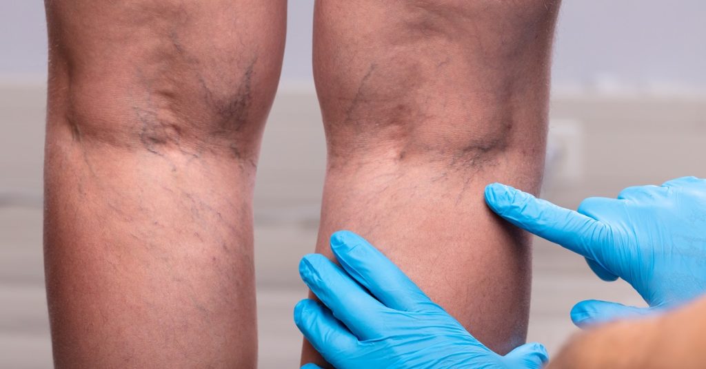 Different Types of Vein Treatments