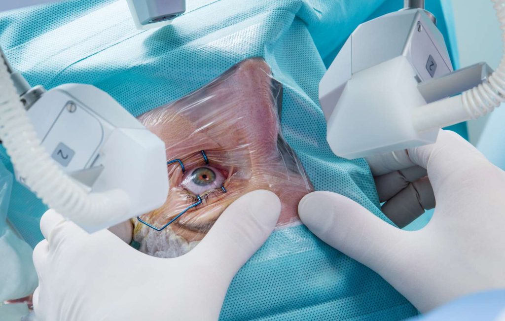Laser Cataract Surgery