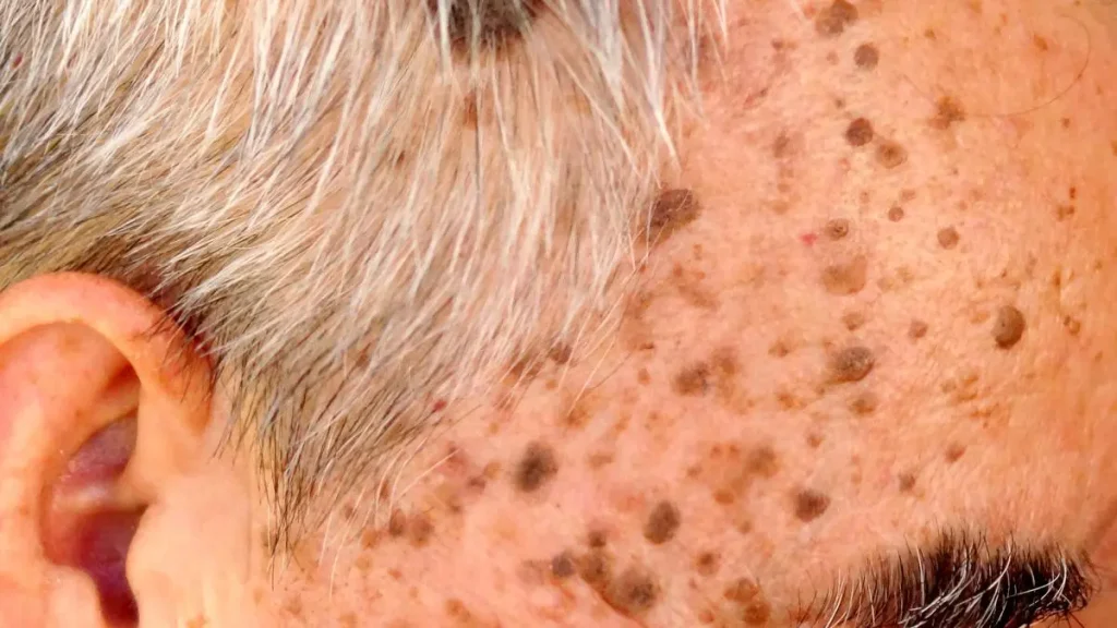 Seborrheic Keratosis