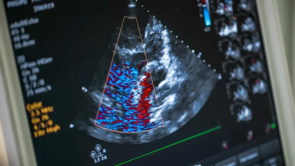 Echocardiogram Results Explained