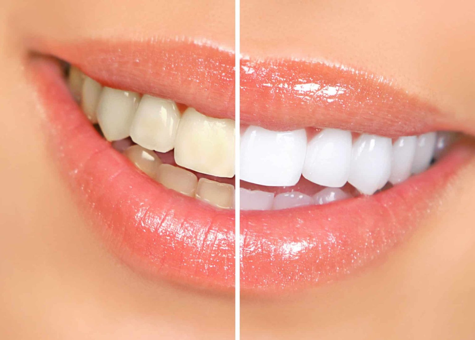 Impact of Teeth Whitening