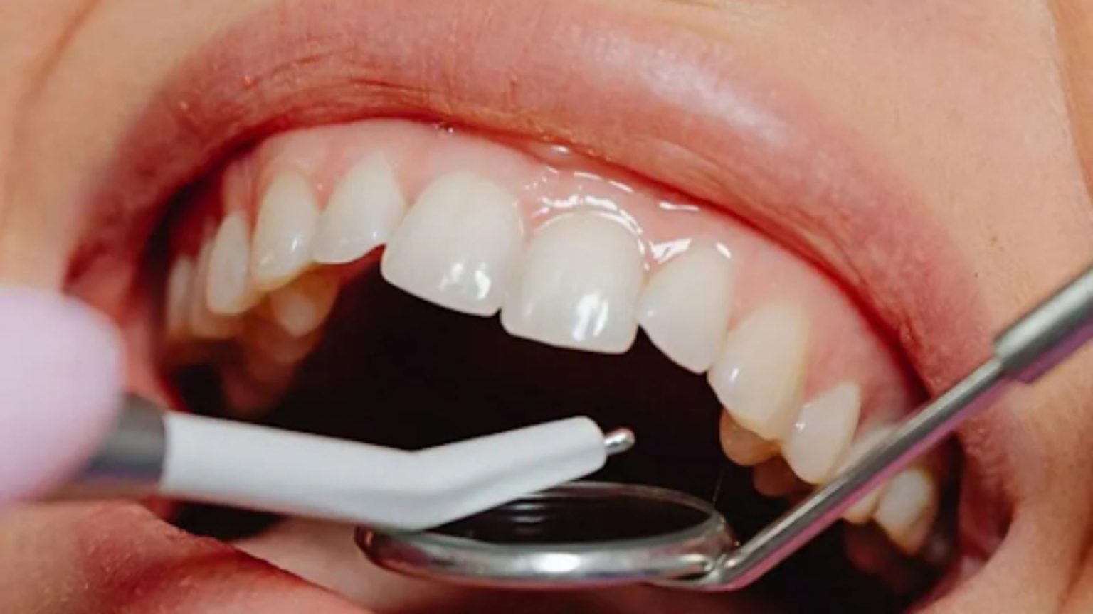 When Is an Apicoectomy Necessary for Tooth Preservation? Apicoectomy Necessary for Tooth Preservation