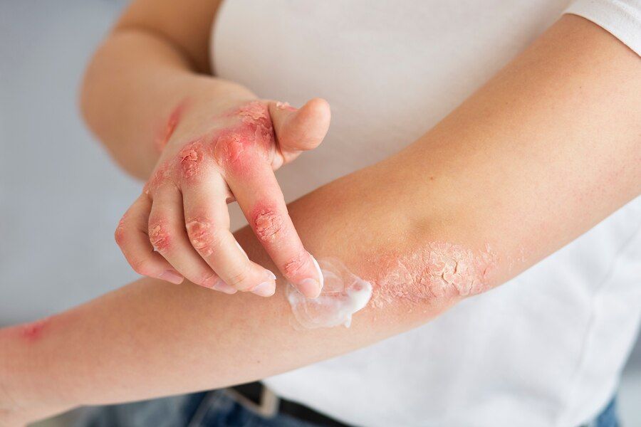 Tips for Coping With Eczema Coping With Eczema