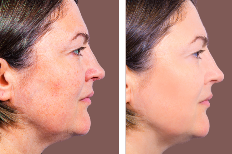 What To Know About Halo Laser Resurfacing Halo Laser Resurfacing