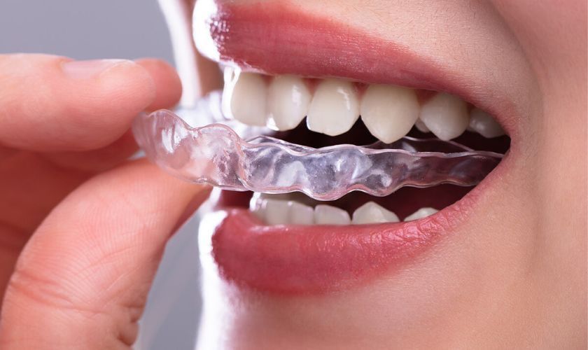 Maintaining Oral Health While Using Invisalign® Maintaining Oral Health While Using Invisalign®