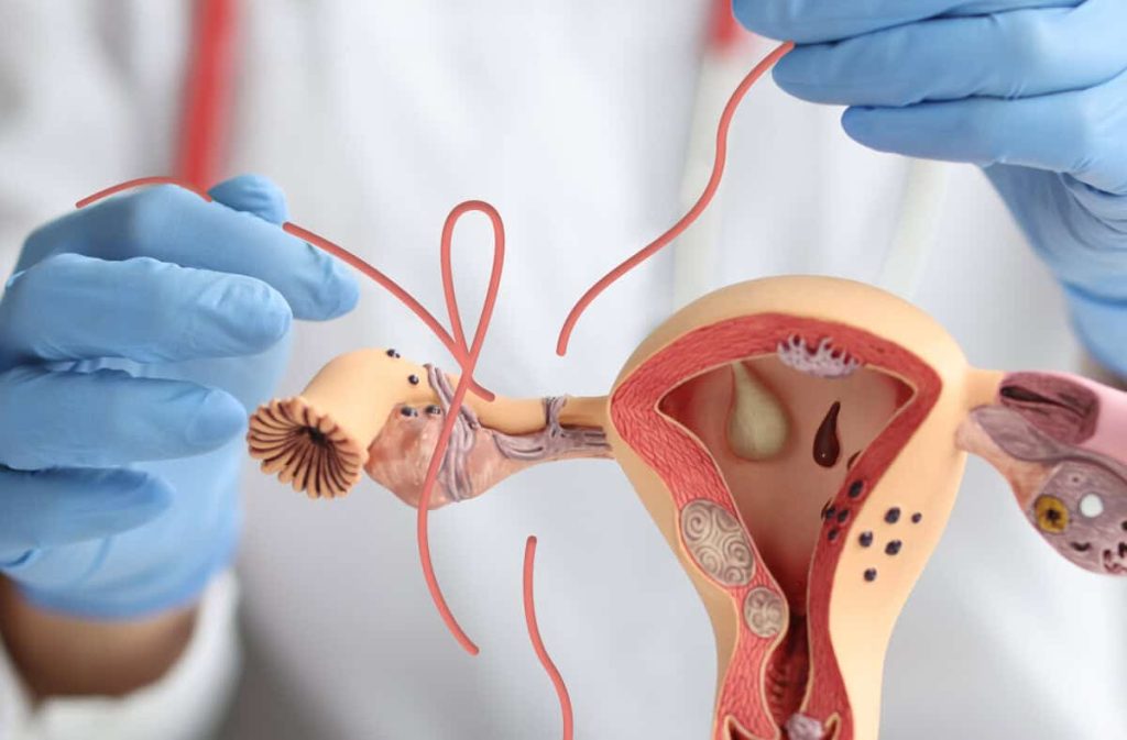 What to Expect When Preparing for Tubal Reversal Surgery Tubal Reversal Surgery