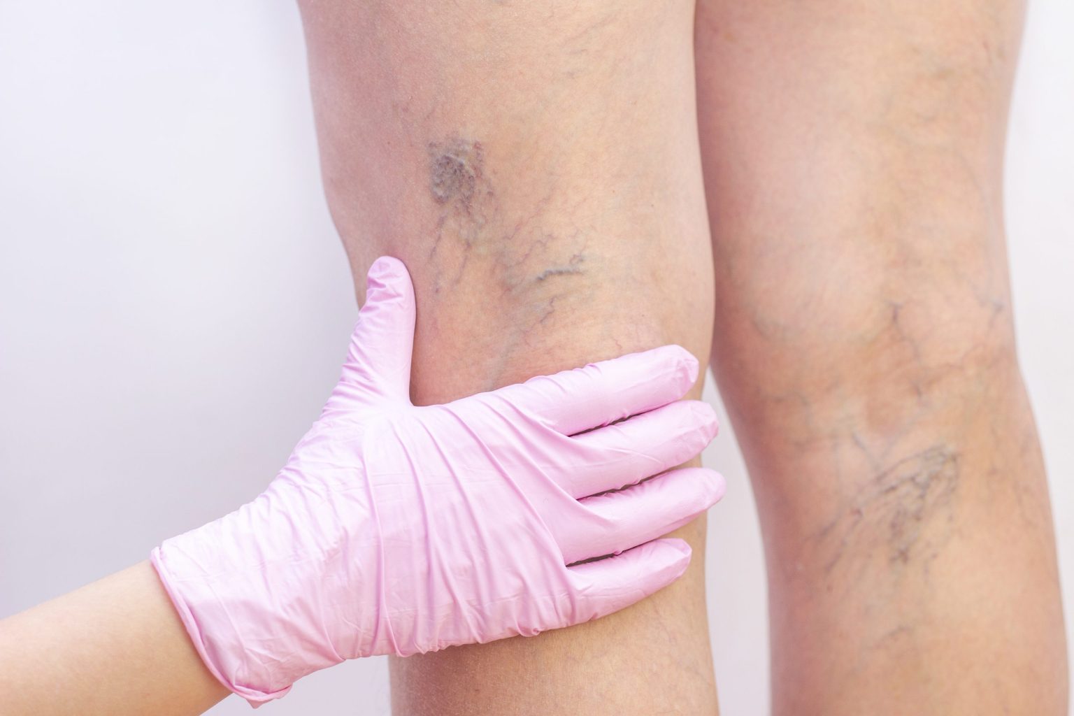 When To Seek Treatment for Varicose Veins