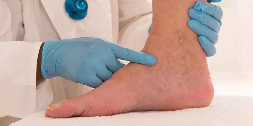 Chronic Venous Insufficiency on Mobility