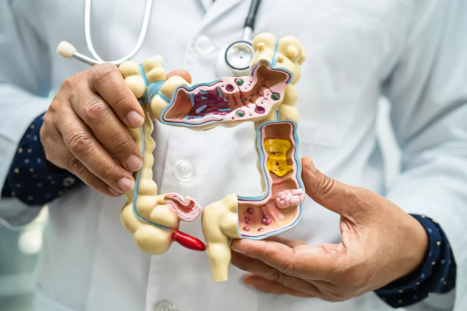 Colon Cancer