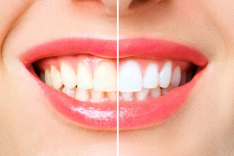 The Science Behind Effective Teeth Whitening Techniques Effective Teeth Whitening Techniques