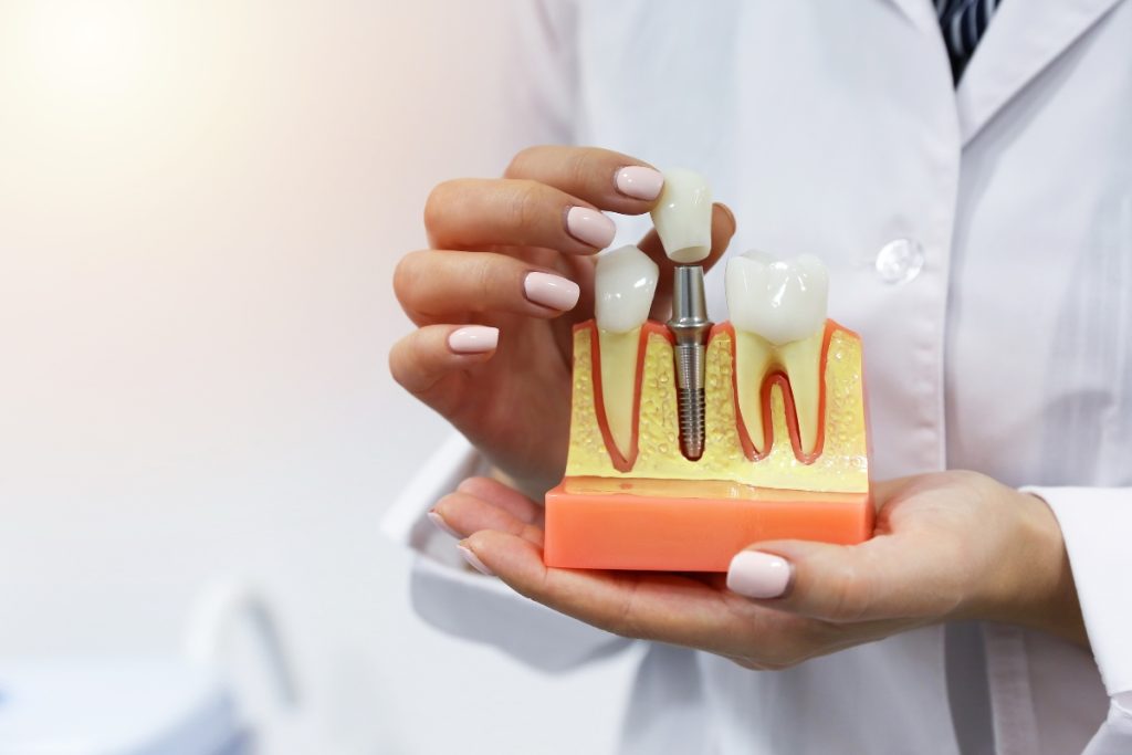 What To Know About the Lifespan of Dental Implants Lifespan of Dental Implants