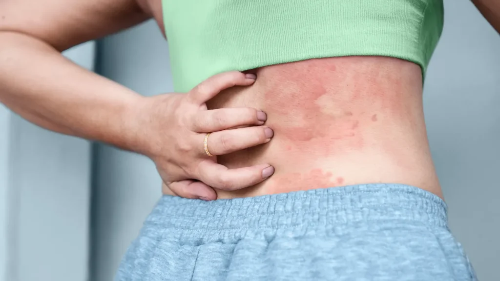 Connection Between Hives and Stress