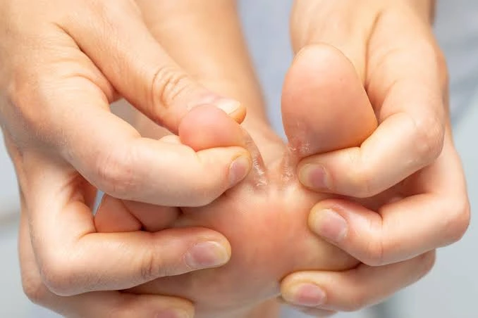 How To Recognize and Treat Common Fungal Infections Common Fungal Infections